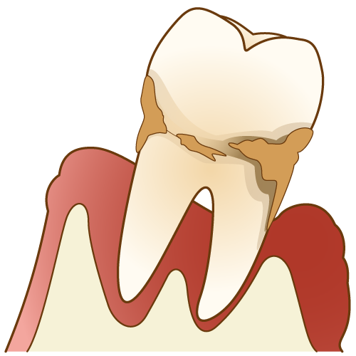 歯周病になるとコロナに感染＆重症化しやすくなります