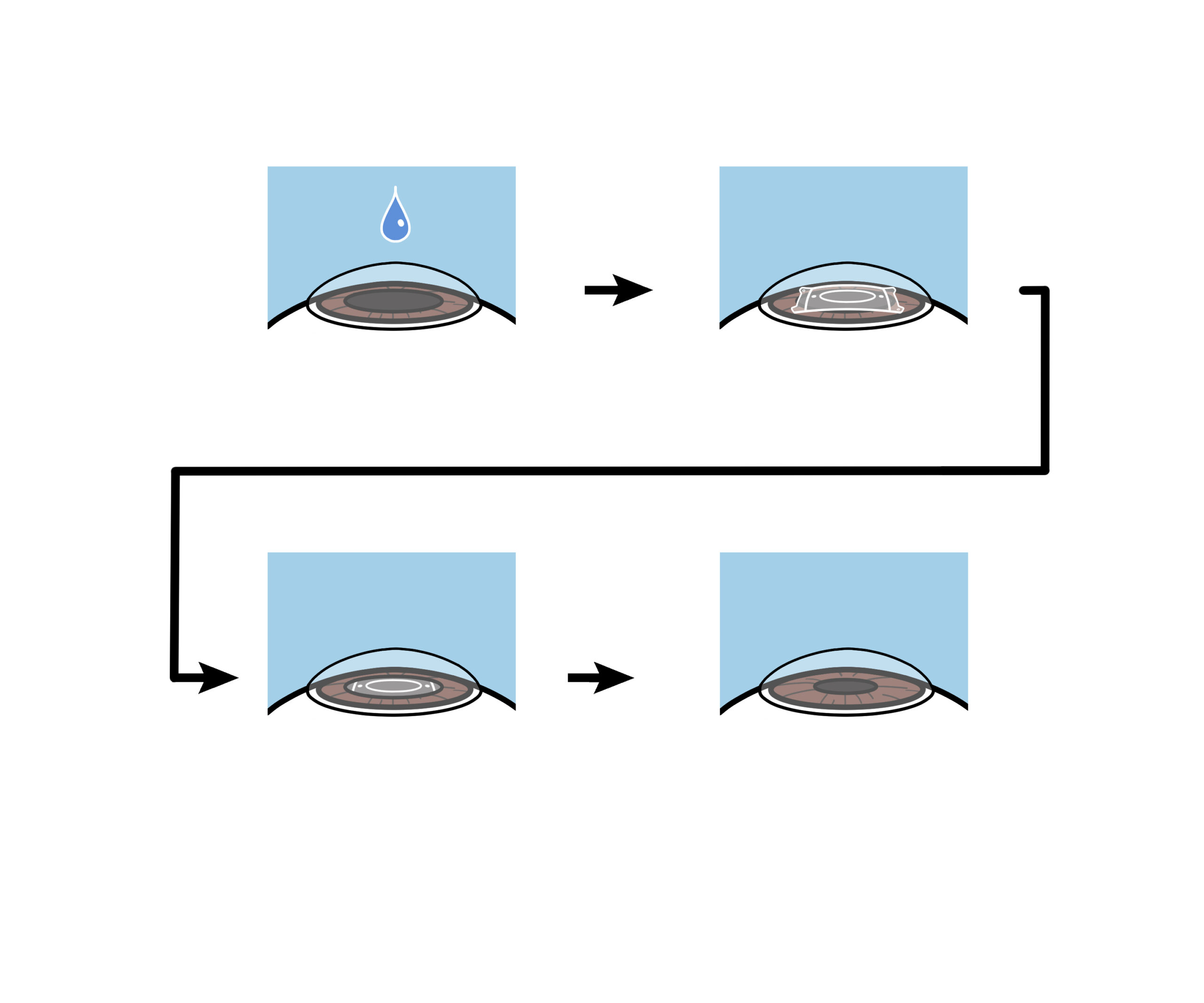 近視を治すICL手術のリスクとメリット
