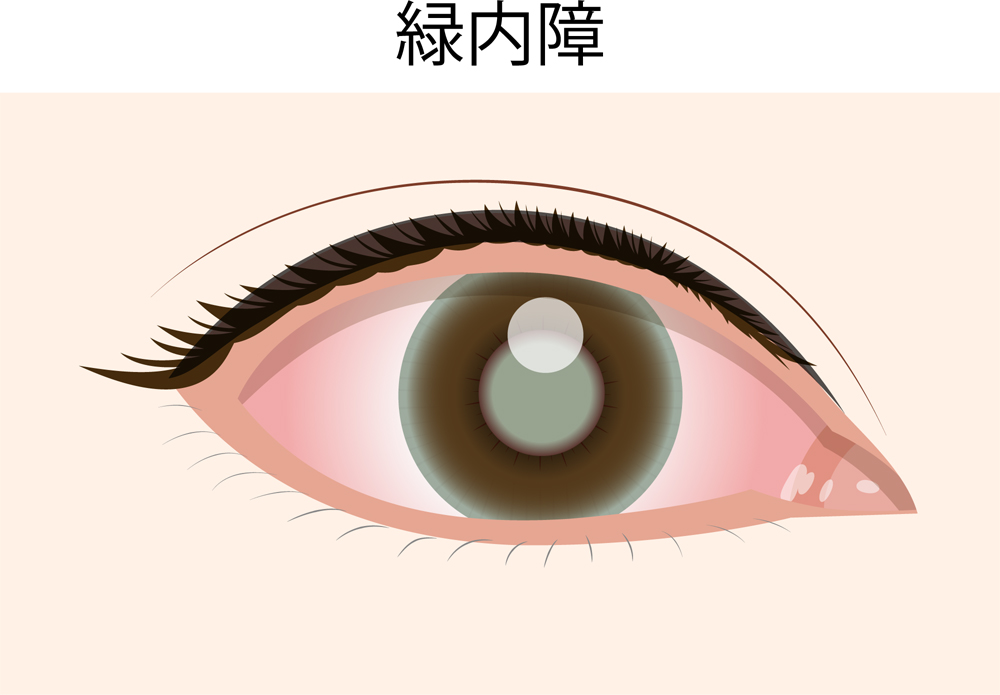 水素は緑内障に効果があるのか。エビデンスを示します